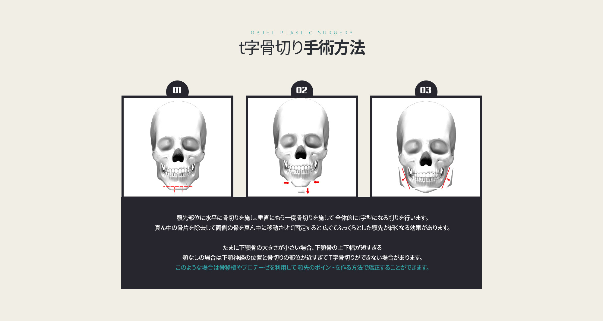 CASE 1. 턱뼈가 크면서 턱끝이 편평한 경우
	Solution 사각턱축소와 턱끝 T절골술을 같이 시행
	